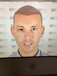 Dr Koray Erdogan - Asmed hair transplant9.jpeg