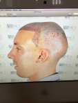 Dr Koray Erdogan - Asmed hair transplant10.jpeg