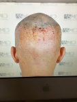 Dr Koray Erdogan - Asmed hair transplant11.jpeg