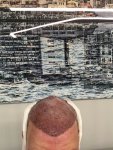 Dr Koray Erdogan - Asmed hair transplant12.jpeg