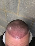 Dr Koray Erdogan - Asmed hair transplant1.jpeg