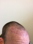 Dr Koray Erdogan - Asmed hair transplant2.jpeg
