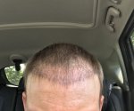 Dr Koray Erdogan - Asmed hair transplant4.jpeg