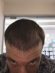 Dr Koray Erdogan - Asmed hair transplant5.jpeg