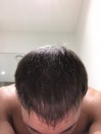 Dr Koray Erdogan - Asmed hair transplant6.jpeg