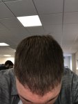 Dr Koray Erdogan - Asmed hair transplant7.jpeg