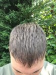 Dr Koray Erdogan - Asmed hair transplant8.jpeg