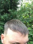 Dr Koray Erdogan - Asmed hair transplant9.jpeg