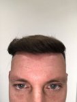 Dr Koray Erdogan - Asmed hair transplant10.jpeg