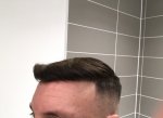 Dr Koray Erdogan - Asmed hair transplant11.jpeg