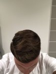 Dr Koray Erdogan - Asmed hair transplant13.jpeg
