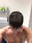 Dr Koray Erdogan - Asmed hair transplant14.jpeg