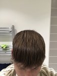 Dr Koray Erdogan - Asmed hair transplant15.jpeg