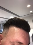 Dr Koray Erdogan - Asmed hair transplant21.jpeg