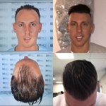 Dr Koray Erdogan - Asmed hair transplant1.jpeg