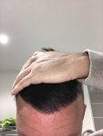 Dr Koray Erdogan - Asmed hair transplant3.jpeg
