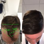 Dr Koray Erdogan - Asmed hair transplant7.jpeg