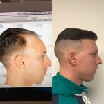 Dr Koray Erdogan - Asmed hair transplant8.jpeg