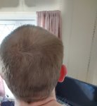 Finasteride 10 months using it.jpeg Finasteride 10 months using it.jpeg