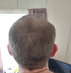 Finsteride 10 months.jpeg Finsteride 10 months.jpeg
