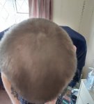 Finasteride after 10 months.jpeg Finasteride after 10 months.jpeg