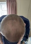 Finasteride for crown growth.jpeg Finasteride for crown growth.jpeg