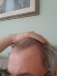 18 year old - is my hairline receding.jpg
