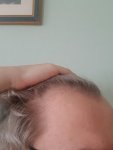 18 year old possibly hair loss in hairline.jpg