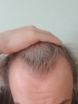 18 year old with hair loss concerns.jpg