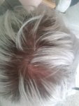 18 year old possibly hair loss in crown.jpg