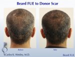 hair transplant scar.jpg hair transplant scar.jpg