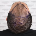 Cosmedica hair transplant3.jpg Cosmedica hair transplant3.jpg