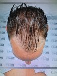 Asmed Hair Transplant Istanbul, Turkey.jpeg Asmed Hair Transplant Istanbul, Turkey.jpeg