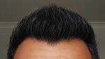 Hairline 6 Month.jpg