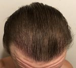 Hair Transplant - Dr Lupanzula1.jpg