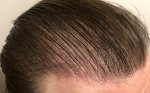 Hair Transplant - Dr Lupanzula 2.jpg