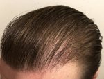 Hair Transplant - Dr Lupanzula 3.jpg