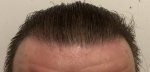Hair Transplant - Dr Lupanzula 4.jpg