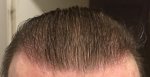 Hair Transplant - Dr Lupanzula 5.jpg
