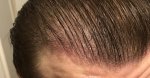 Hair Transplant - Dr Lupanzula 7.jpg
