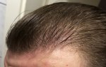 Hair Transplant - Dr Lupanzula 8.jpg