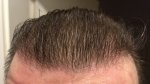 Hair Transplant - Dr Lupanzula 9.jpg