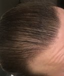 Hair Transplant - Dr Lupanzula 10.jpg