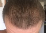 Hair Transplant - Dr Lupanzula 11.jpg