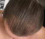 Hair Transplant - Dr Lupanzula 12.jpg