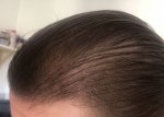 Hair Transplant - Dr Lupanzula 13.jpg