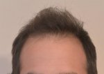 hattingen hair transplant-Dr muresanu1.jpg