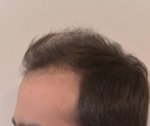 hattingen hair transplant-Dr muresanu2.jpg