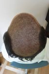 hattingen hair transplant-Dr muresanu8.jpg