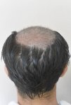 hattingen hair transplant-Dr muresanu11.jpg